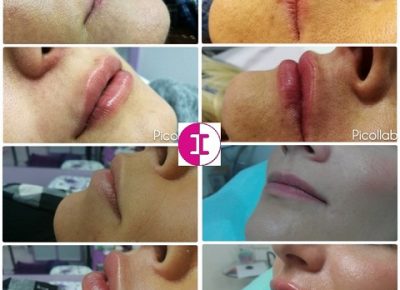 EpilacijaDorcolAkcija(6)1612183707